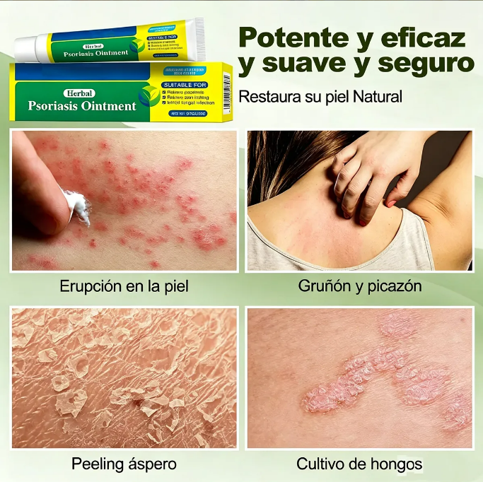 Pack 2x1 DermaCalm™ Para Aliviar Psoriarsis | Ayuda a Aliviar la Sensación de Comezón, Enrojecimiento e Irritación + 🎁 Guía “21 Hábitos para Cuidar tu Piel Todos los Días” + Envío Gratis