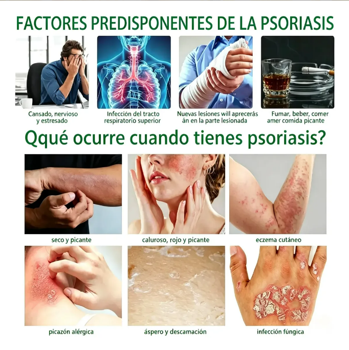 Pack 2x1 DermaCalm™ Para Aliviar Psoriarsis | Ayuda a Aliviar la Sensación de Comezón, Enrojecimiento e Irritación + 🎁 Guía “21 Hábitos para Cuidar tu Piel Todos los Días” + Envío Gratis